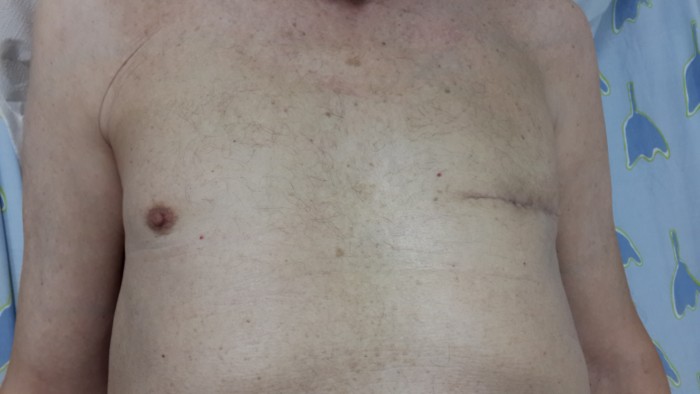 ניתוח לא שגרתי: גבר כבן 70 מאשדוד עבר ניתוח להסרת גידול סרטני בשד